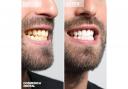 Teeth Whitening in Turkey at Cosmedica Dental