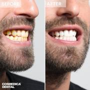 Teeth Whitening in Turkey at Cosmedica Dental